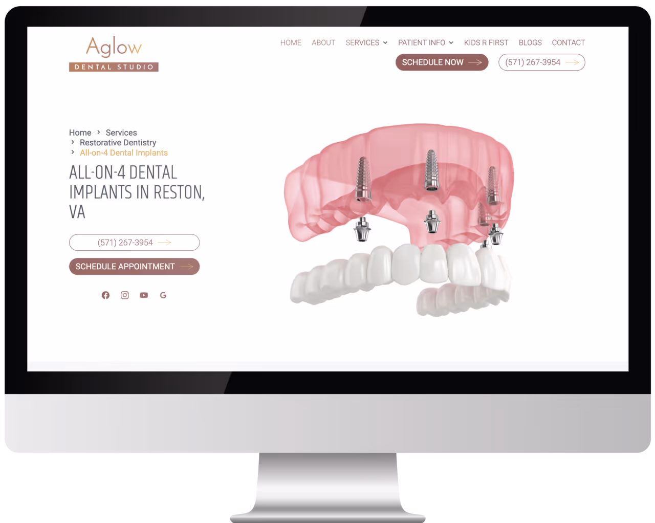 Full-arch implant ad with transparent all-inclusive pricing offer